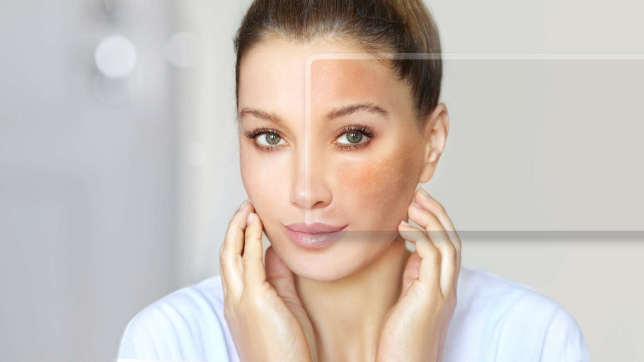 Can Melasma Be Removed?