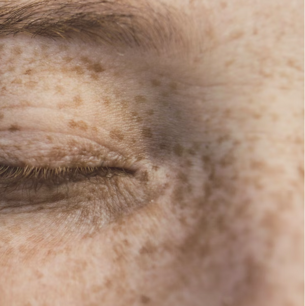 All You Need To Know About Pigmentation